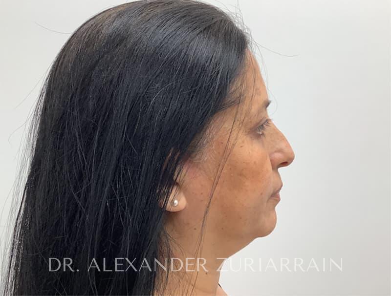 Blepharoplasty before & after photo