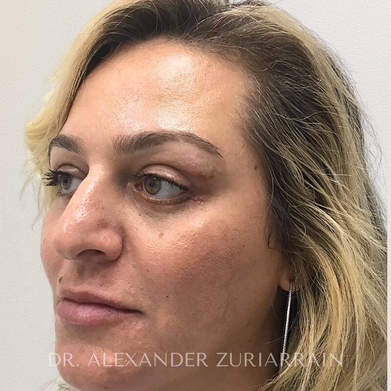 Blepharoplasty before & after photo