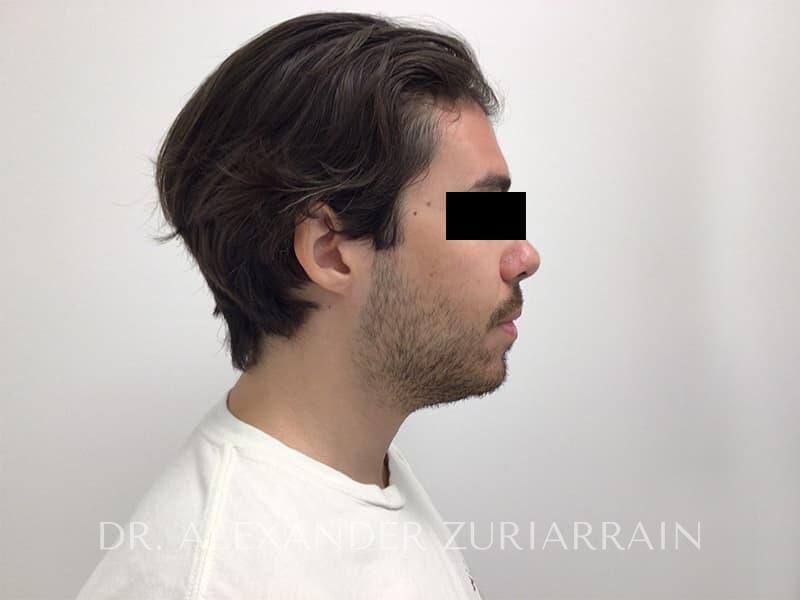Chin implant before & after photo
