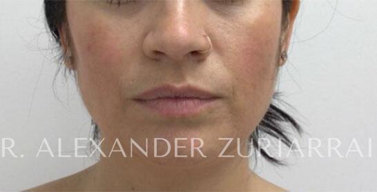Facial fat grafting before & after photo
