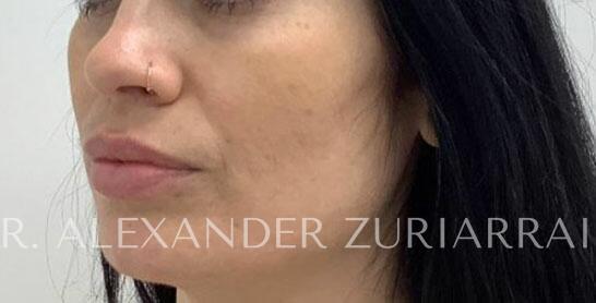Facial fat grafting before & after photo