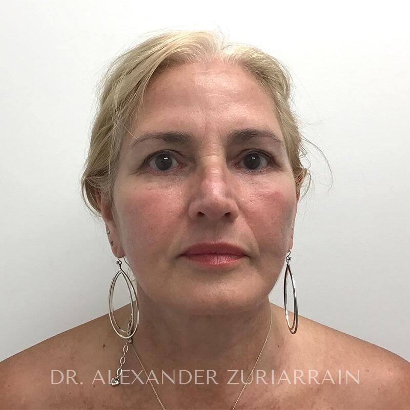 Neck lift before & after photo