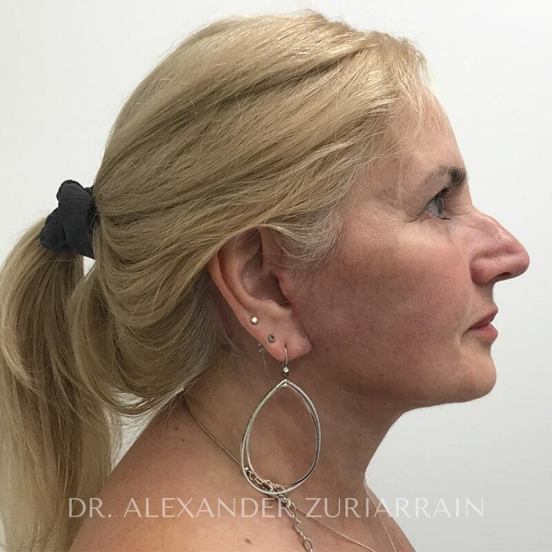 Neck lift before & after photo