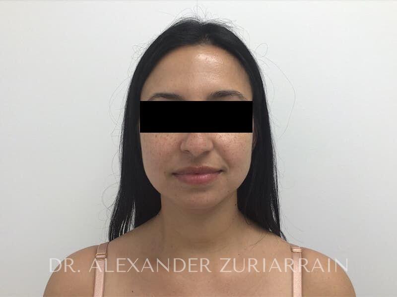 Neck liposuction before & after photo