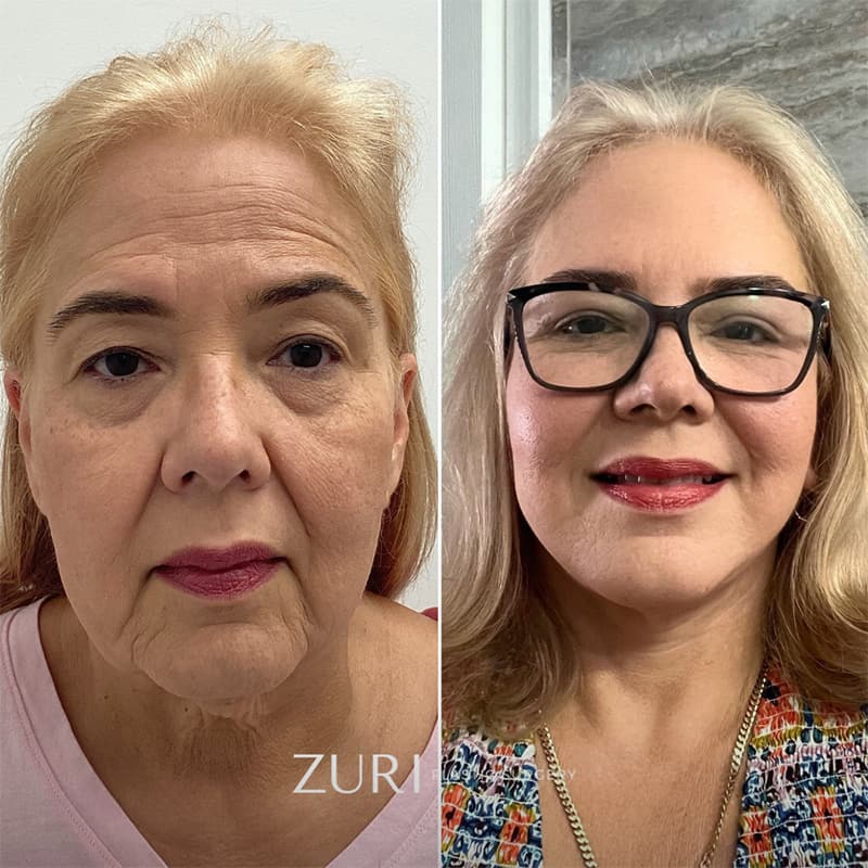Featured before & after photo